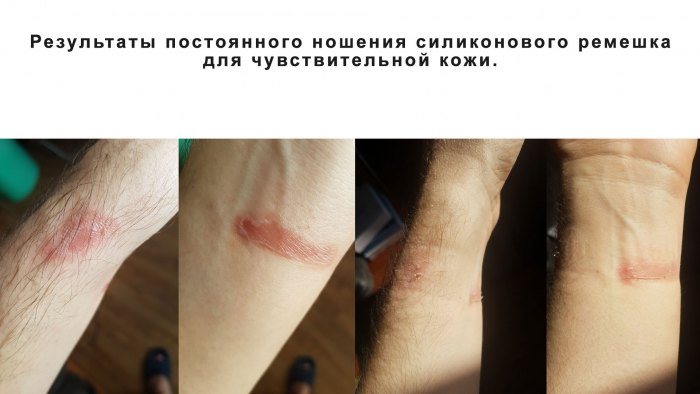 Результаты постоянного ношения силиконового ремешка для чувствительной кожи